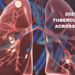 2023 Rise in Tuberculosis Cases Across California