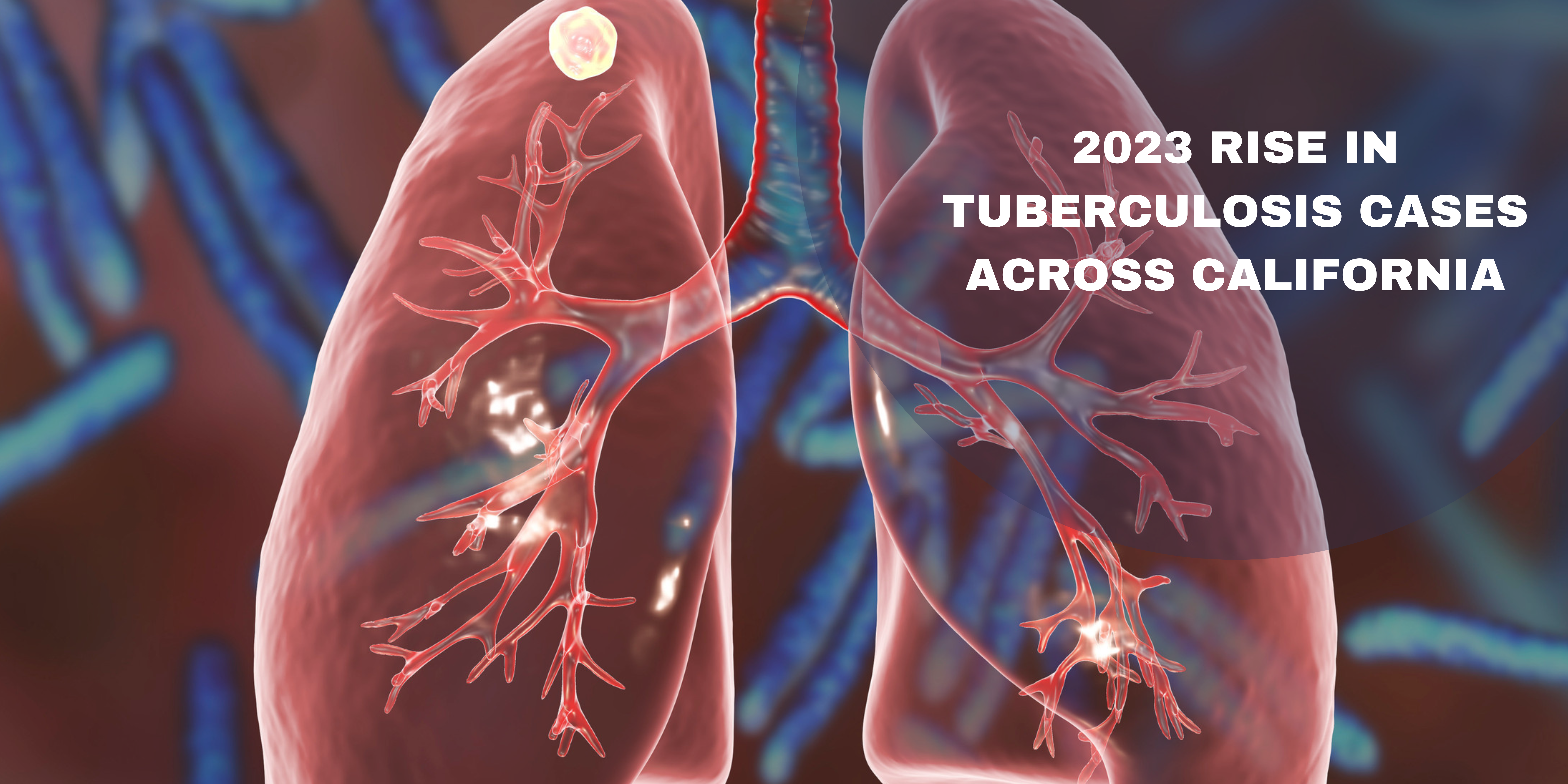 2023 Rise in Tuberculosis Cases Across California